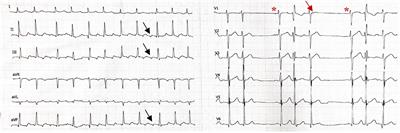 Paroxysmal Atrial Fibrillation Originating From the Inferior Vena Cava: A Case Report and Literature Review